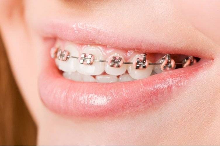 Girl with braces